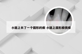 小腿上长了一个圆形的癣 小腿上圆形癣很痒
