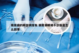 银屑病的眼部病变有 银屑病眼睛不舒服是怎么回事