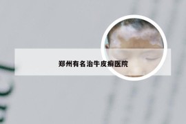 郑州有名治牛皮癣医院
