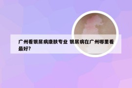 广州看银屑病康肤专业 银屑病在广州哪里看最好?