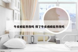 牛皮癣能熬夜吗 得了牛皮病癣能熬夜吗
