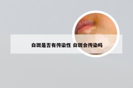 白斑是否有传染性 白斑会传染吗