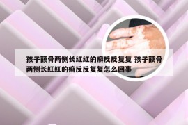 孩子颧骨两侧长红红的癣反反复复 孩子颧骨两侧长红红的癣反反复复怎么回事