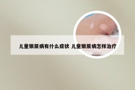 儿童银屑病有什么症状 儿童银屑病怎样治疗