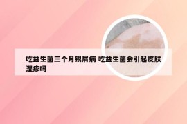吃益生菌三个月银屑病 吃益生菌会引起皮肤湿疹吗