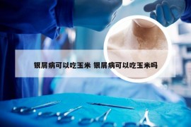 银屑病可以吃玉米 银屑病可以吃玉米吗
