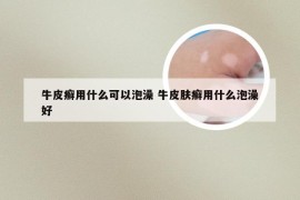 牛皮癣用什么可以泡澡 牛皮肤癣用什么泡澡好