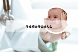 牛皮癣会传染给人么