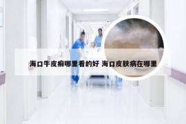海口牛皮癣哪里看的好 海口皮肤病在哪里