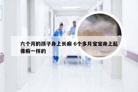 六个月的孩子身上长癣 6个多月宝宝身上起像癣一样的