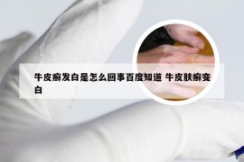 牛皮癣发白是怎么回事百度知道 牛皮肤癣变白
