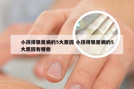 小孩得银屑病的5大原因 小孩得银屑病的5大原因有哪些