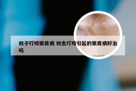 蚊子叮咬银屑病 蚊虫叮咬引起的银屑病好治吗