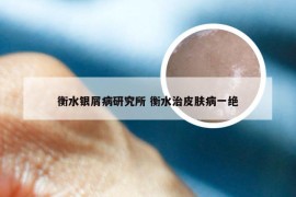 衡水银屑病研究所 衡水治皮肤病一绝