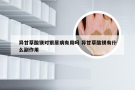 异甘草酸镁对银屑病有用吗 异甘草酸镁有什么副作用