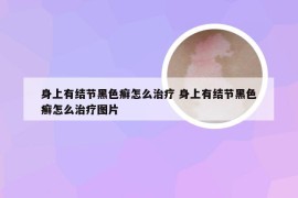 身上有结节黑色癣怎么治疗 身上有结节黑色癣怎么治疗图片