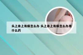 头上身上有癣怎么办 头上身上有癣怎么办用什么药