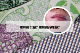 银屑病仓治疗 银屑病药物治疗