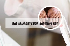 治疗皮肤癣最好的医院 治癣医院哪家好