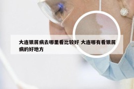大连银屑病去哪里看比较好 大连哪有看银屑病的好地方