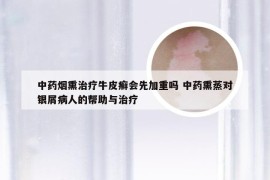 中药烟熏治疗牛皮癣会先加重吗 中药熏蒸对银屑病人的帮助与治疗