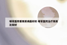 哪家医院看银屑病最好的 哪家医院治疗银屑比较好