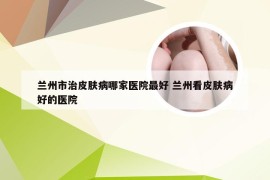 兰州市治皮肤病哪家医院最好 兰州看皮肤病好的医院