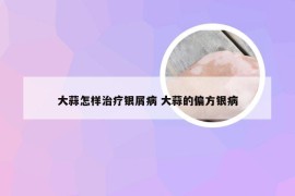 大蒜怎样治疗银屑病 大蒜的偏方银病
