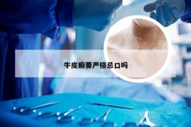 牛皮癣要严格忌口吗