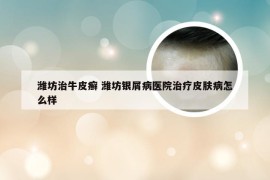 潍坊治牛皮癣 潍坊银屑病医院治疗皮肤病怎么样