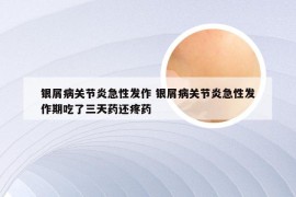 银屑病关节炎急性发作 银屑病关节炎急性发作期吃了三天药还疼药