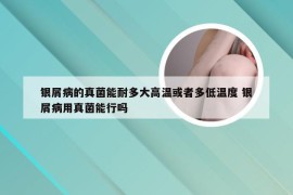 银屑病的真菌能耐多大高温或者多低温度 银屑病用真菌能行吗