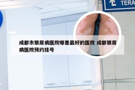 成都市银屑病医院哪里最好的医院 成都银屑病医院预约挂号
