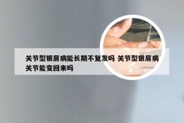 关节型银屑病能长期不复发吗 关节型银屑病关节能变回来吗