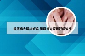 银屑病去深圳好吗 银屑病去深圳好吗知乎