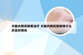 大腿内侧皮肤癣治疗 大腿内侧皮肤癣用什么药膏好得快