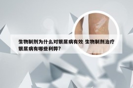 生物制剂为什么对银屑病有效 生物制剂治疗银屑病有哪些利弊?