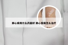 脚心癣用什么药最好 脚心有癣怎么治疗