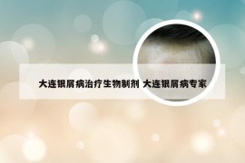 大连银屑病治疗生物制剂 大连银屑病专家