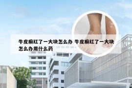 牛皮癣红了一大块怎么办 牛皮癣红了一大块怎么办用什么药