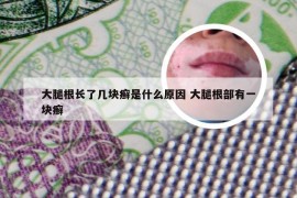 大腿根长了几块癣是什么原因 大腿根部有一块癣