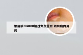 银屑病NBUvB加过大剂量后 银屑病内用药