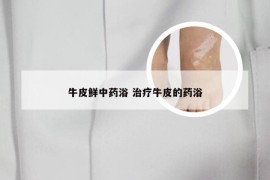 牛皮鲜中药浴 治疗牛皮的药浴