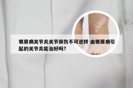 银屑病关节炎关节损伤不可逆转 由银屑病引起的关节炎能治好吗?