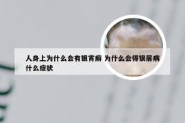 人身上为什么会有银宵癣 为什么会得银屑病什么症状