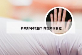 白斑好不好治疗 白斑如何自愈