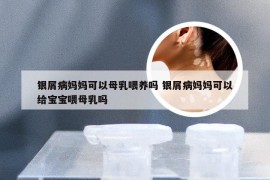 银屑病妈妈可以母乳喂养吗 银屑病妈妈可以给宝宝喂母乳吗