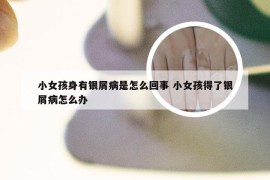 小女孩身有银屑病是怎么回事 小女孩得了银屑病怎么办