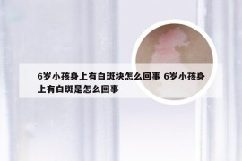 6岁小孩身上有白斑块怎么回事 6岁小孩身上有白斑是怎么回事