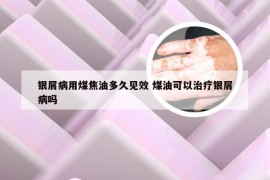 银屑病用煤焦油多久见效 煤油可以治疗银屑病吗